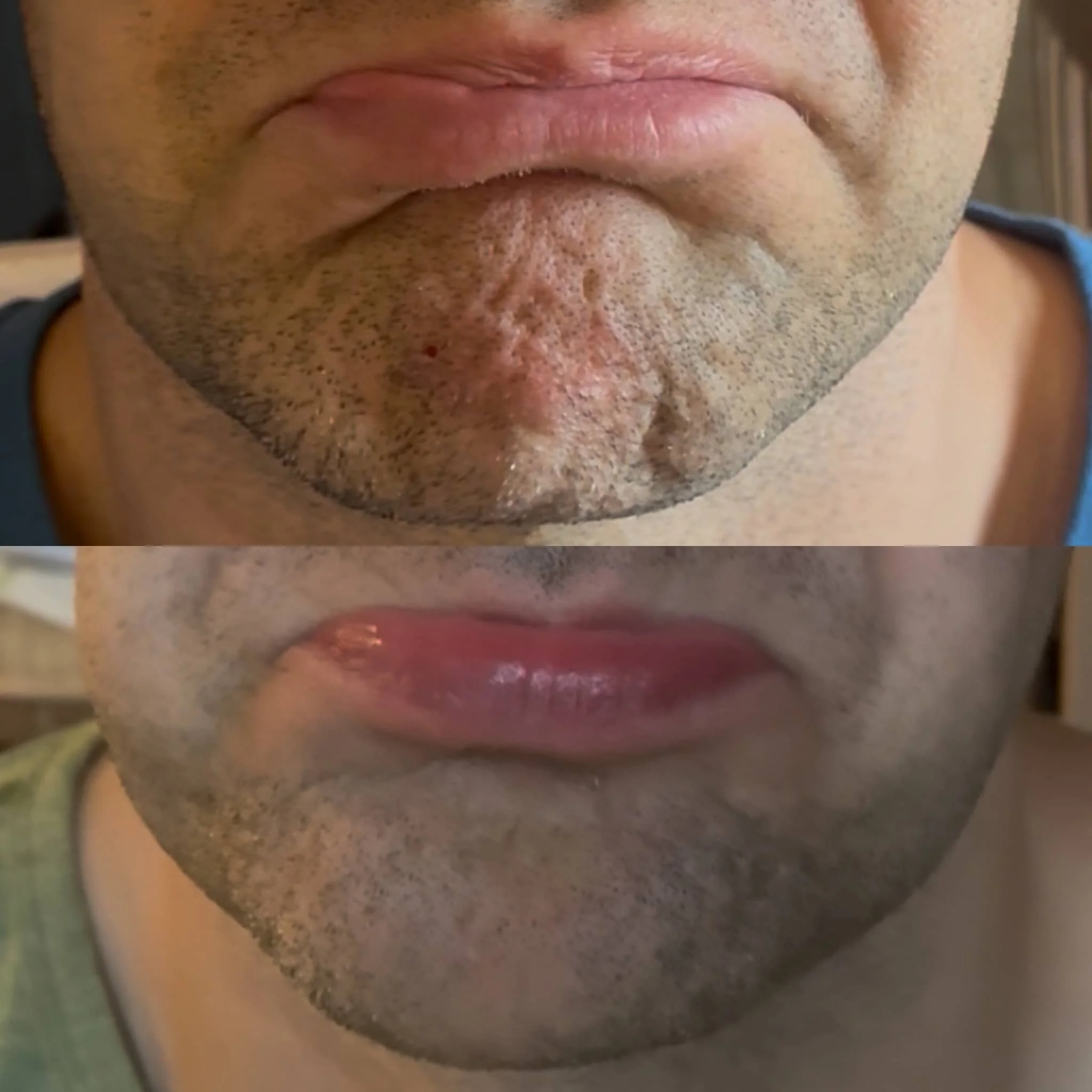 Close-up of a person's lower face showing the transition from a beard to clean-shaven, with the top half displaying a stubbled beard and the bottom half showing a freshly shaved smooth face.