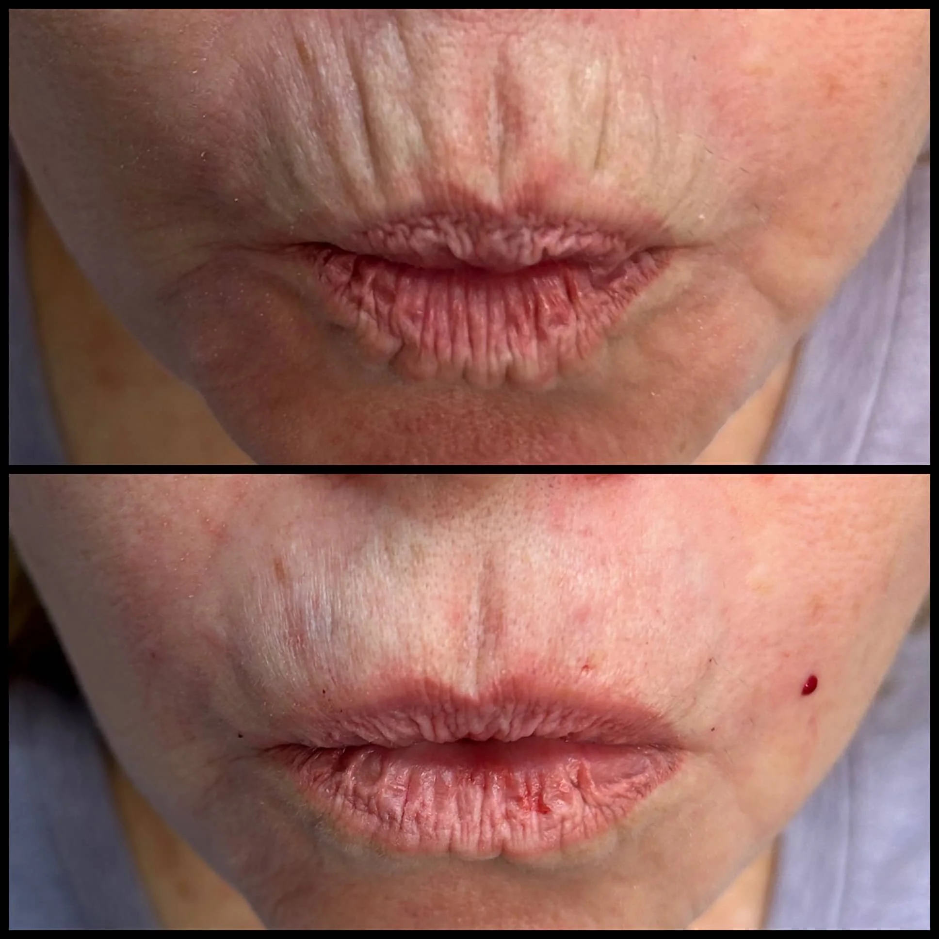 Close-up of a person's lips before and after a cosmetic procedure, showing dryness and cracking in the top image and improved hydration with slight bleeding in the bottom image.