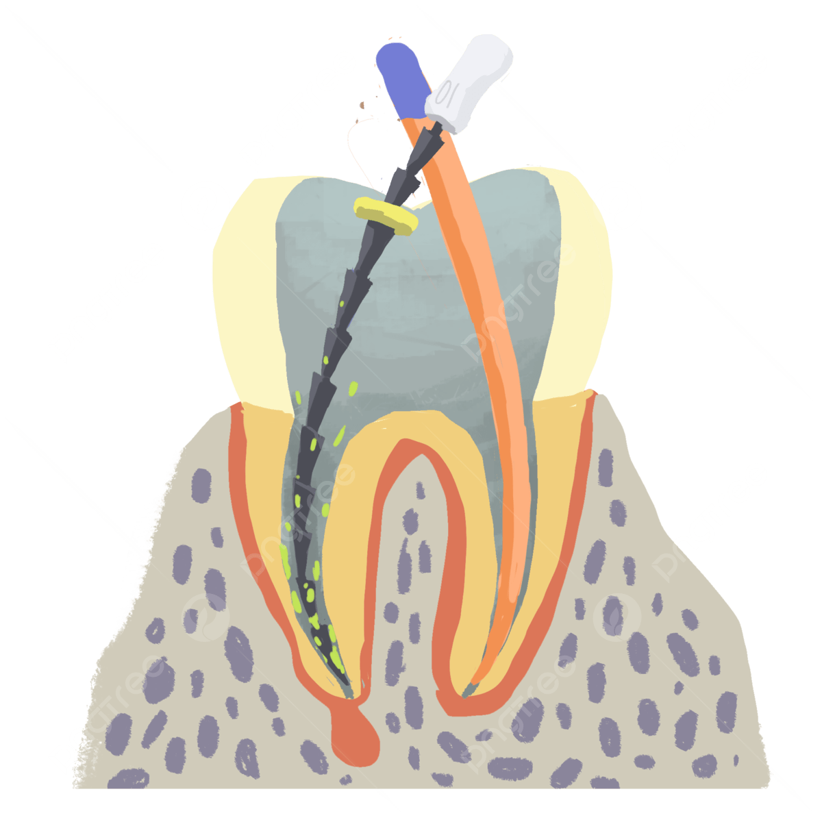 Endodontics (Root canal therapy)