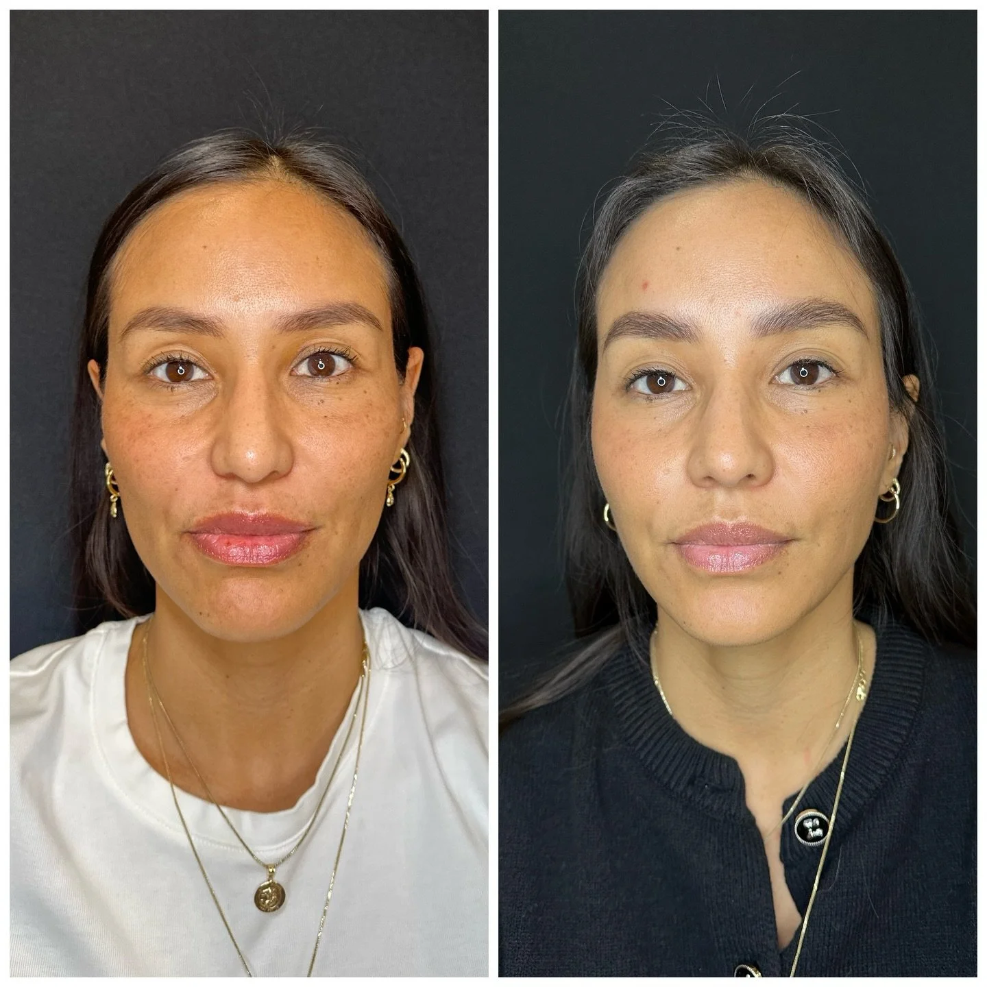 This subtle transformation 💗 will make you smile for days!! 

If you want &ldquo;just a little something&rdquo; to improve the way you look and the way you feel - let&rsquo;s talk! 

Booking link in Bio 🔗
✨THE STUNNING FEELING✨@bombon.aesthetics
☎️