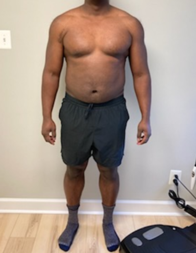 Before treatment, Medical Weight Loss