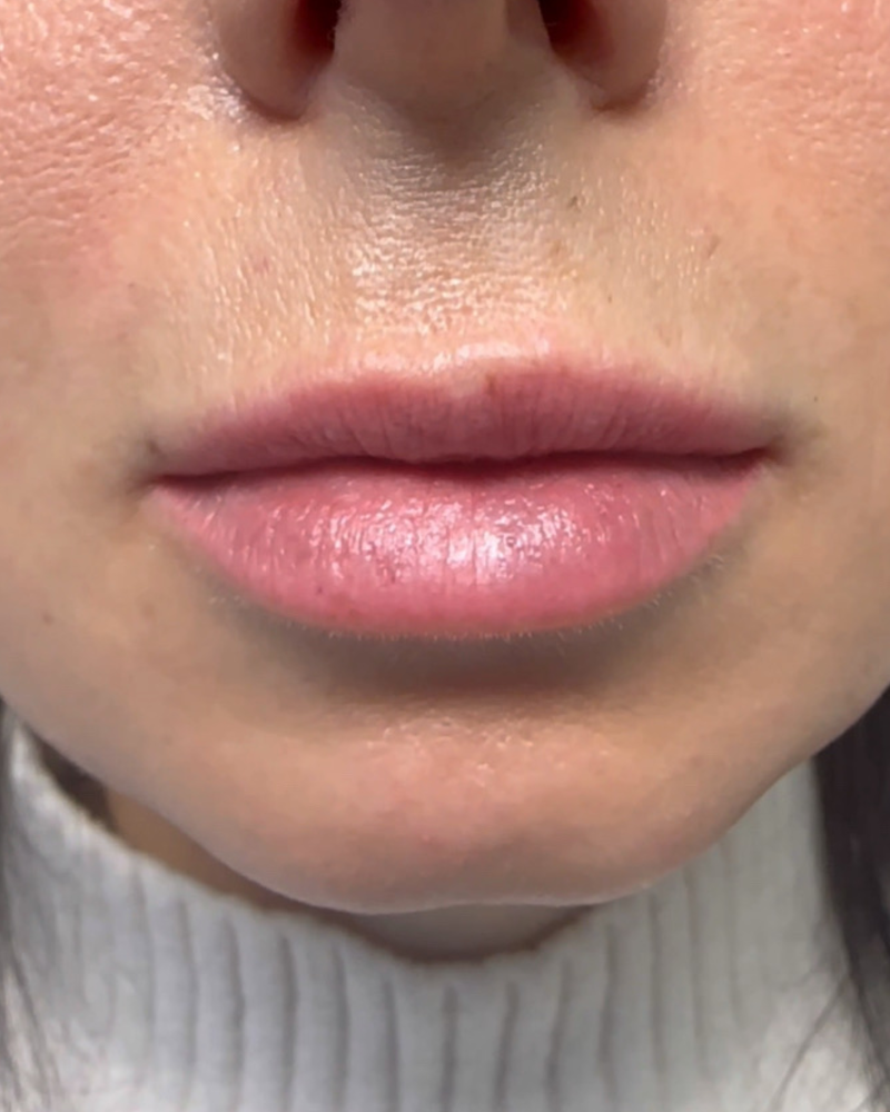 Before treatment, Natural Lip Filler