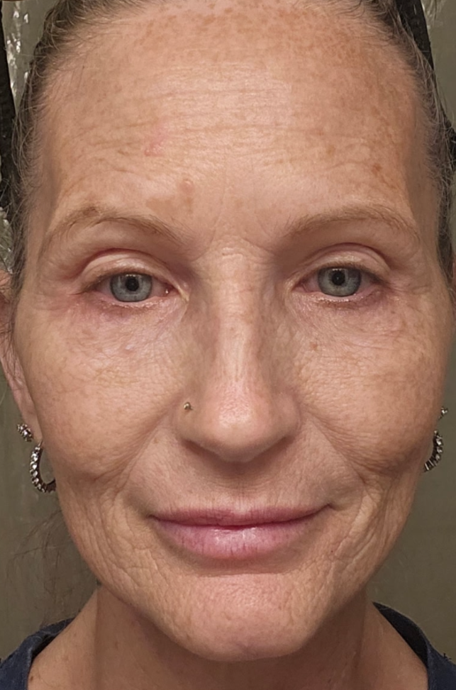 After treatment, Botox and Filler