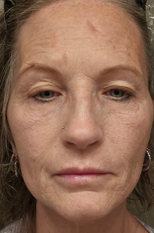 Before treatment, Botox and Filler
