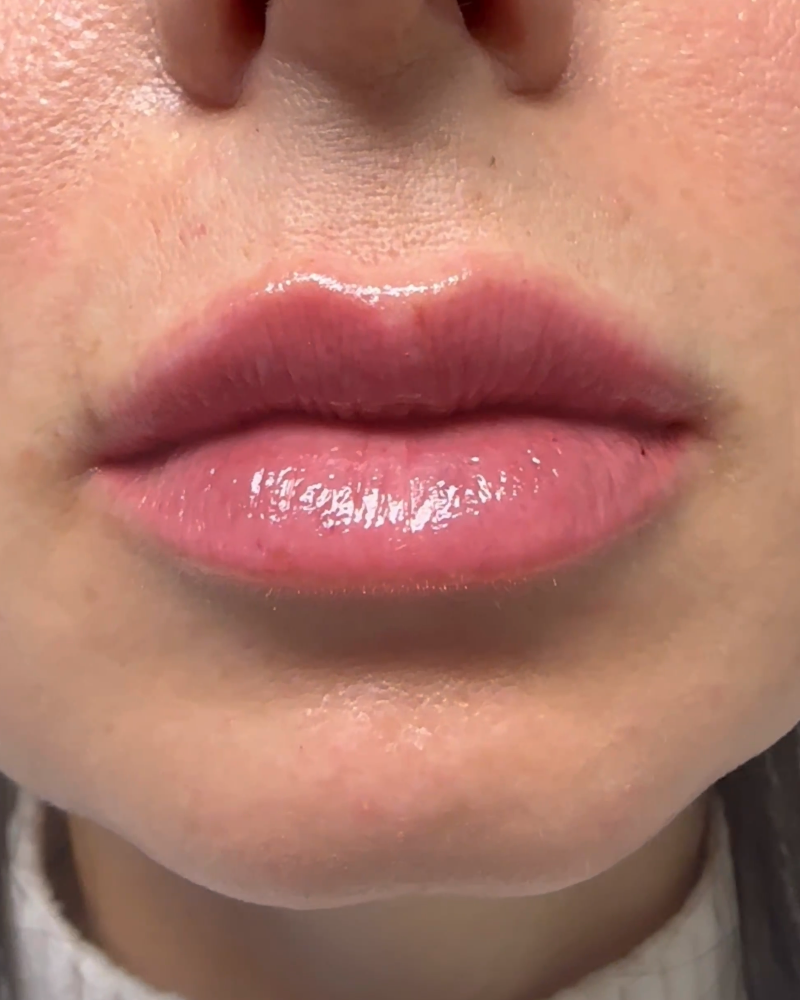 After treatment, Natural Lip Filler