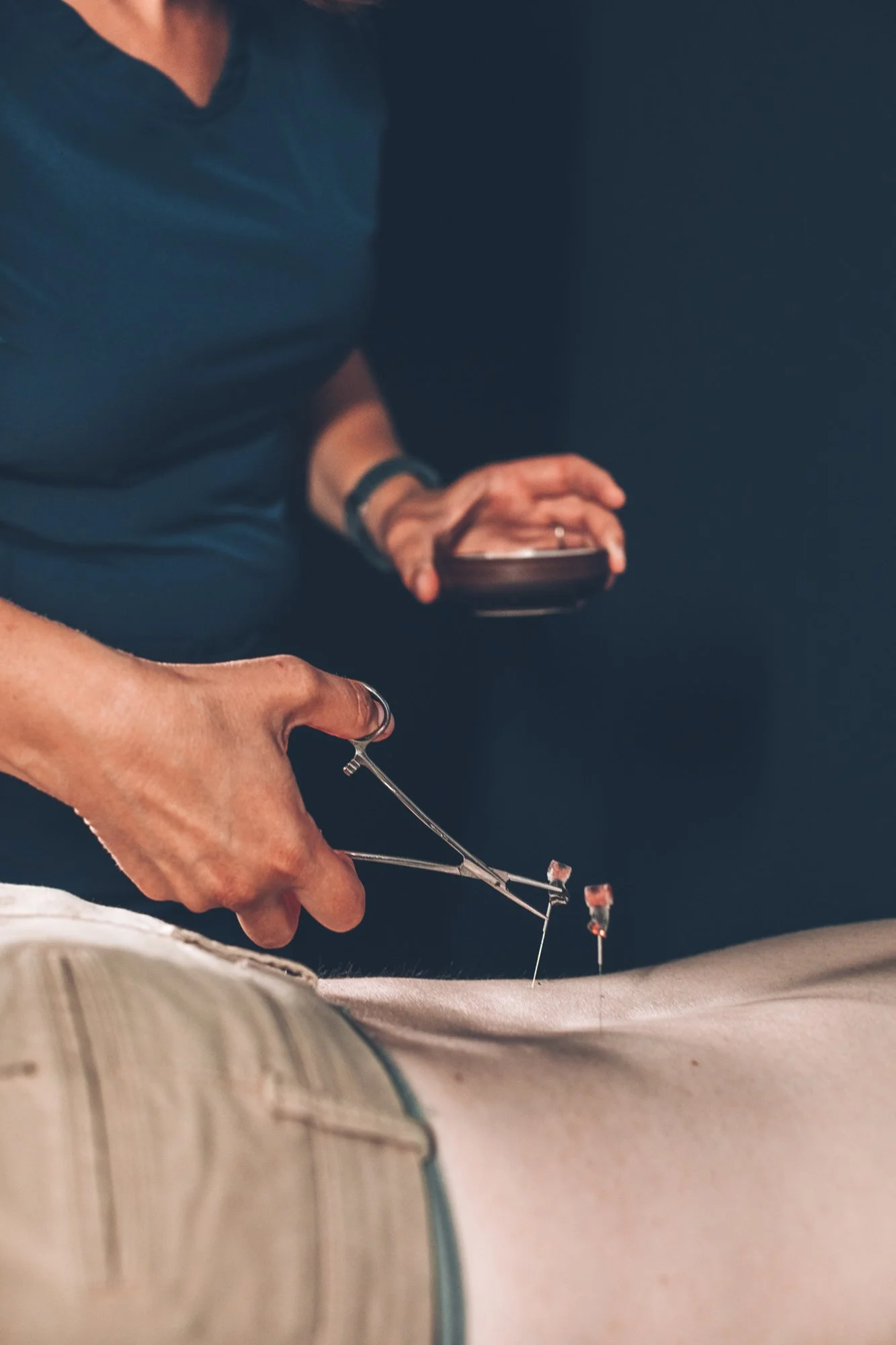 Soul Sprout practitioner performing Moxa therapy on a client.