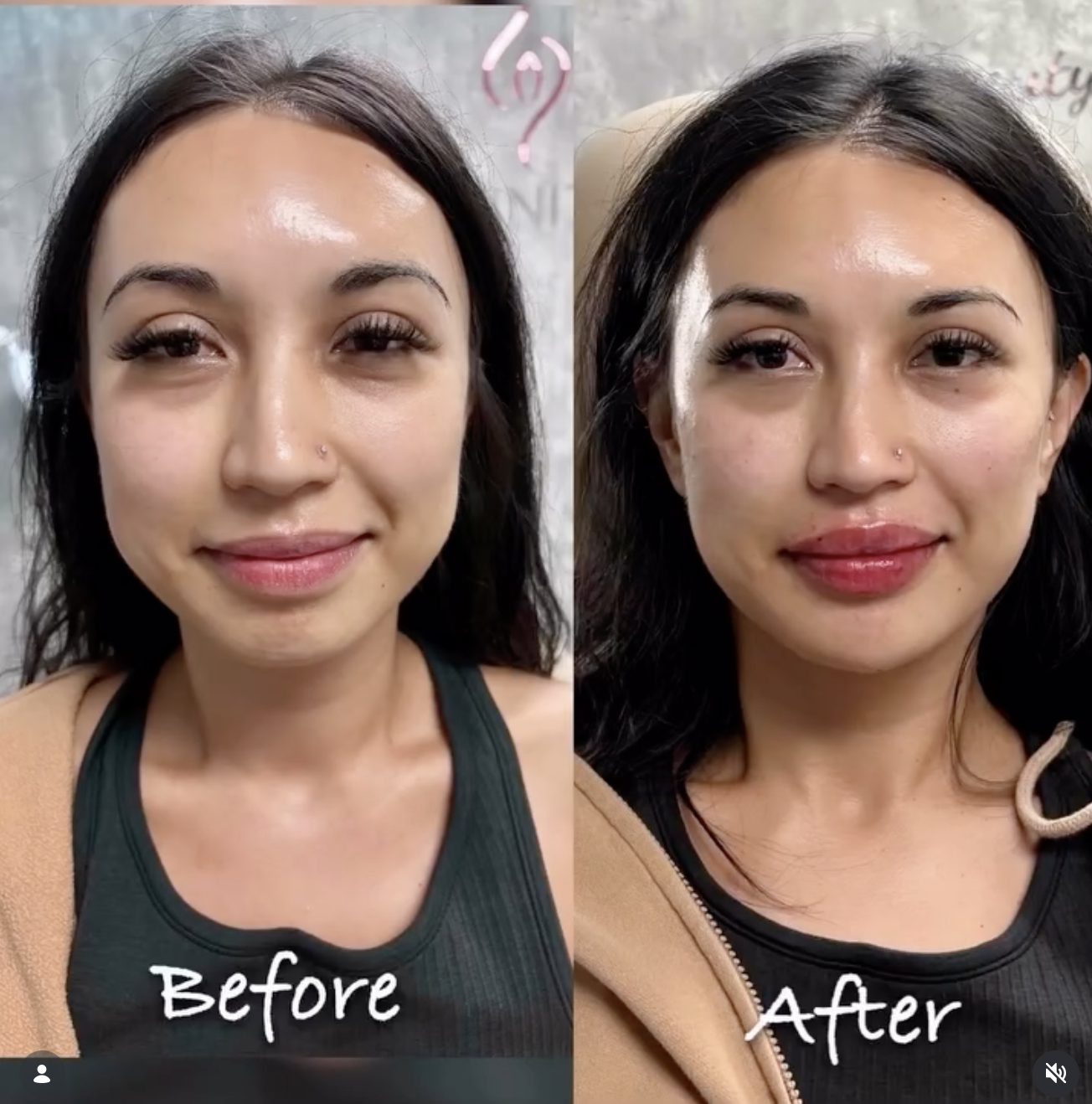 Before and after HA filler with Evolysse