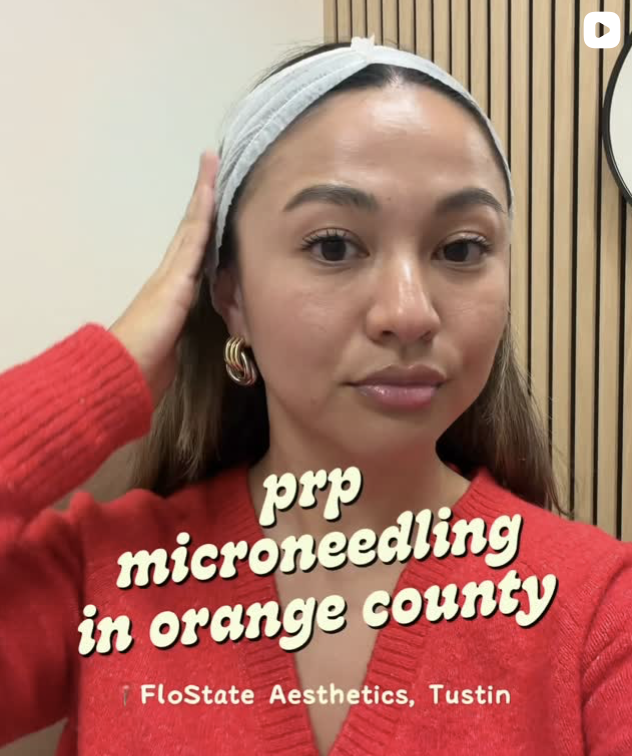 Microneedling in Orange County, CA