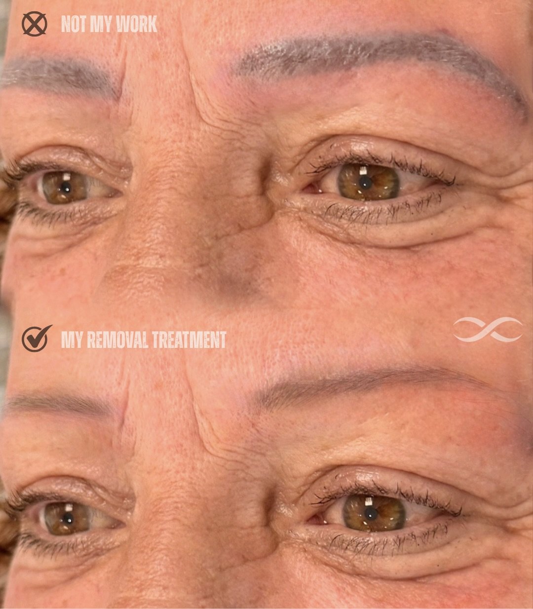 Close-up of a person's eyes and forehead with a before and after comparison of a cosmetic procedure, showing reduced wrinkles and smoother skin in the after image.
