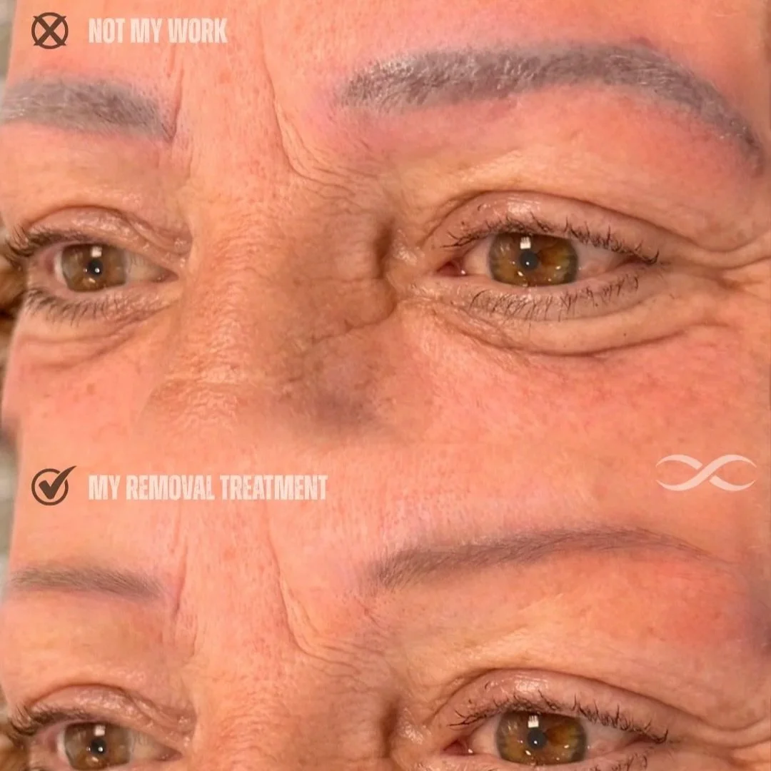 Close-up of an elderly person's eye area showing before and after cosmetic treatment for wrinkles, with text indicating 'NOT MY WORK' for the before image and 'MY REMOVAL TREATMENT' for the after image.
