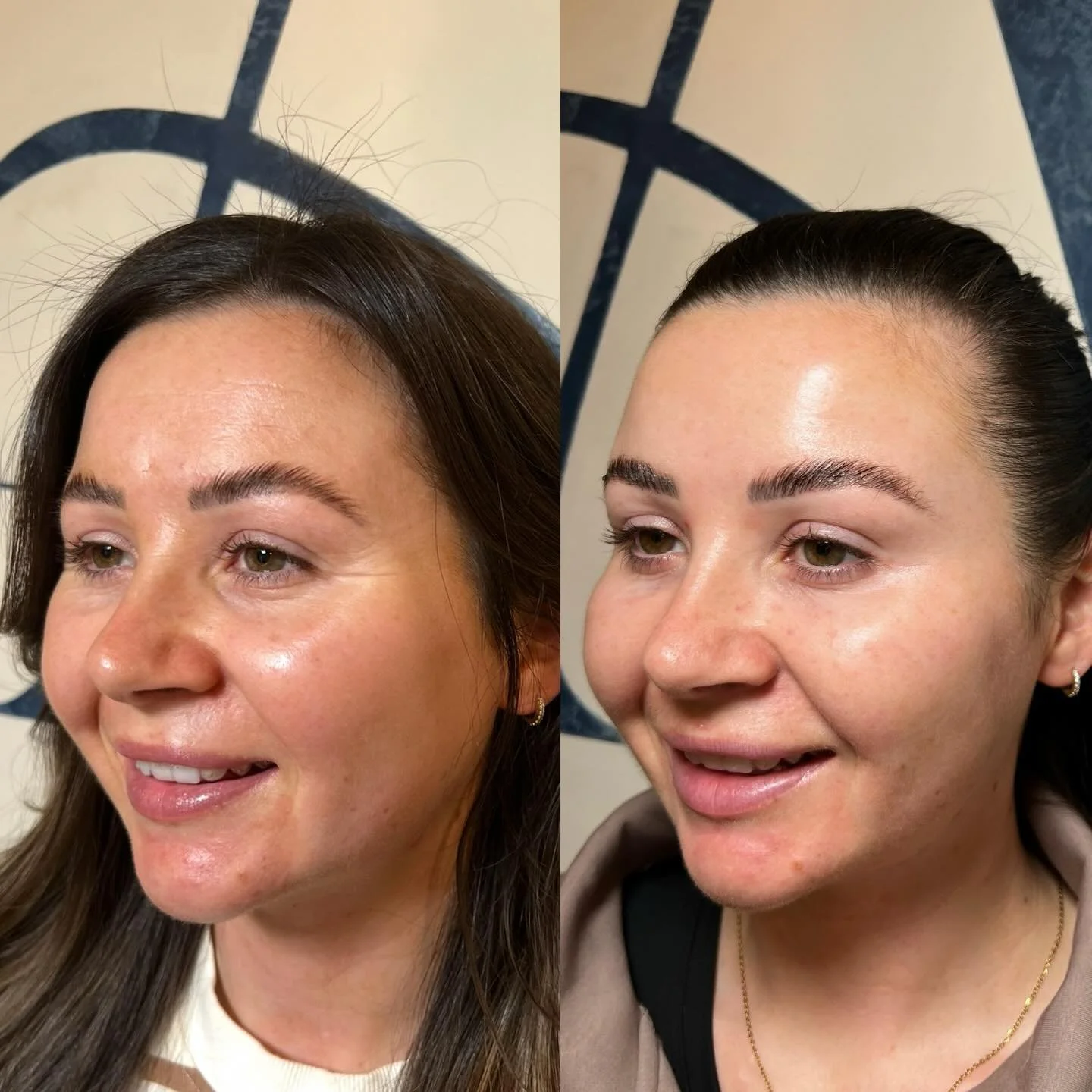 That two week glow✨

After just two weeks from initial appointment you can see the forehead lines have gone as well as the lines around the eyes.