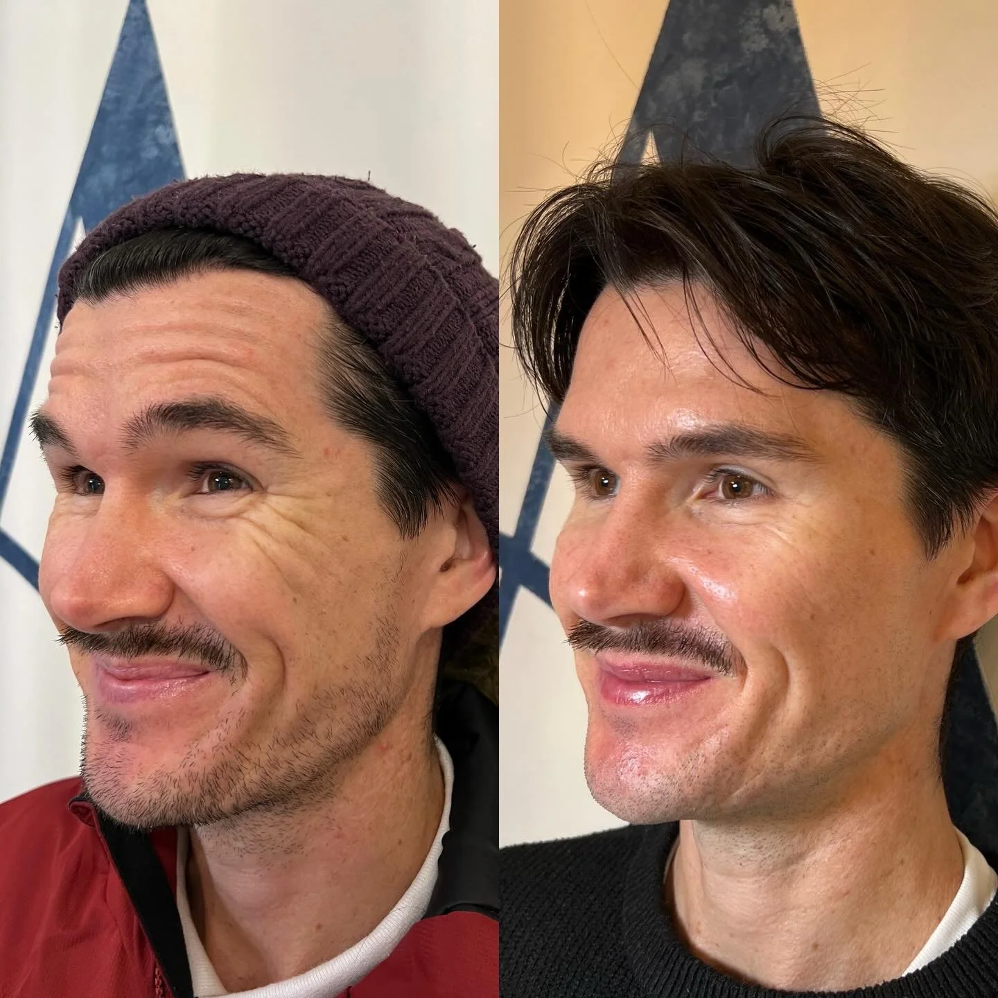 Would you ever think my client had come off a night shift? Because me either💁🏽&zwj;♀️

Tailored injections = beautiful results.

Brief was to soften lines and look more refreshed for a big birthday coming up and I think we nailed it.