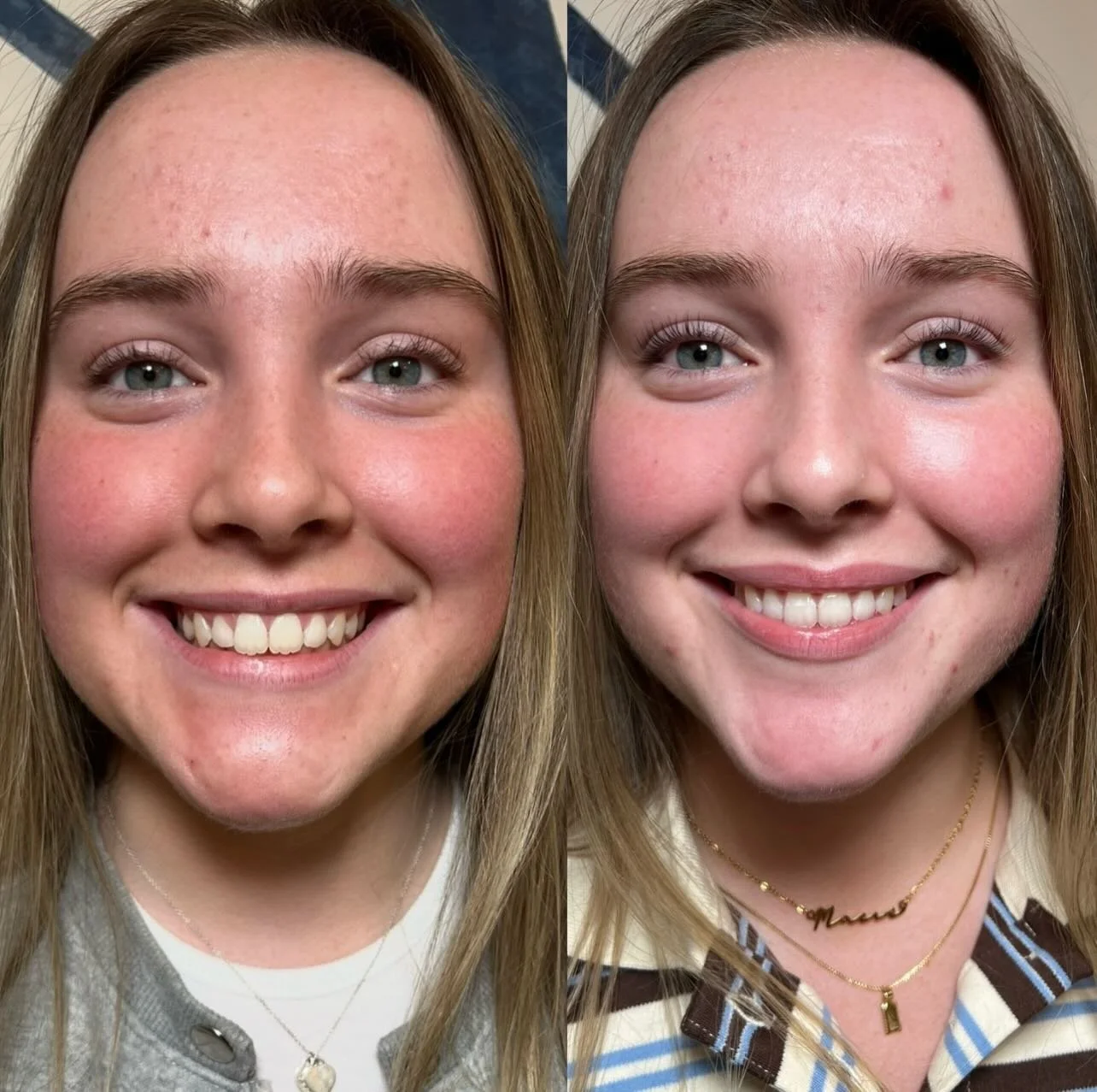 Little tweaks so subtle, others won&rsquo;t notice but you will notice are my favourite ✨

Can you spot the treatment here?

If you guess treatment to the gummy smile and lip shape (without filler) you would be correct.

Beautifully tailored injectio