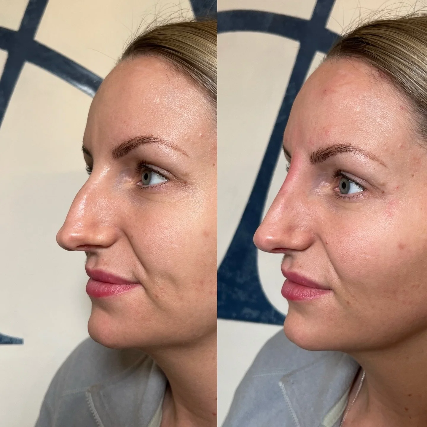 Keep them guessing 🪄

Refine your profile instantly with a non-surgical rhinoplasty. We used dermal filler to smooth and enhance symmetry for our lovely client - and the results speak for themselves 😍

Ready for side-profile goals? Book your consul