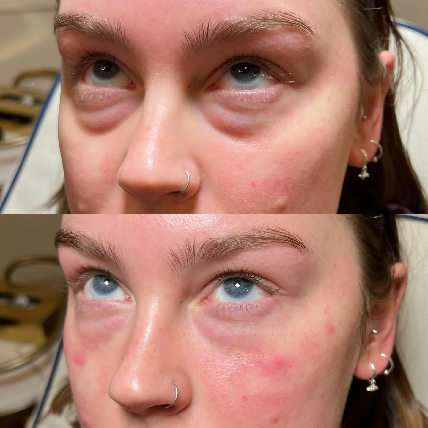 Now, many practitioners may not have treated my client for tear trough filler and rightfully so.

They would see that the orbital fat pads have herniated past the orbital septum (a thin membrane, that&rsquo;s holds the fat in place) and turned the cl