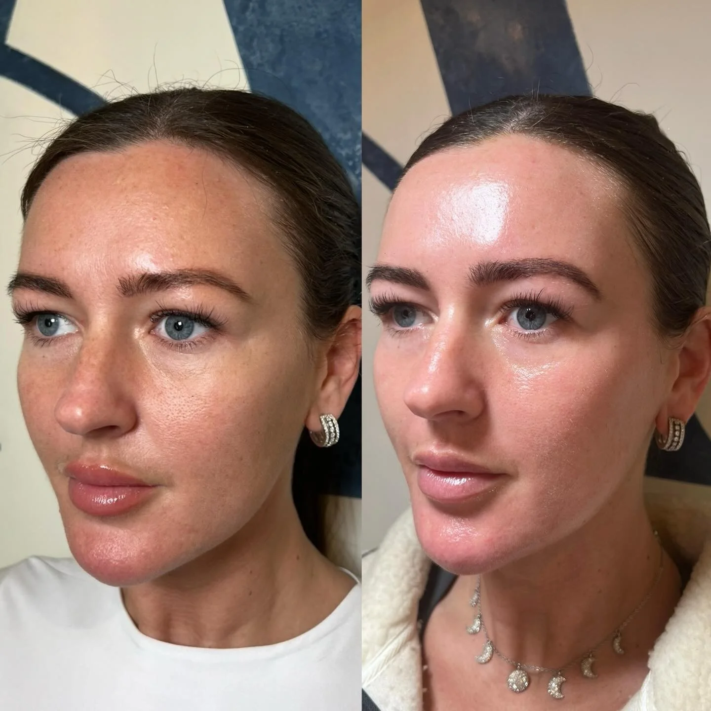 C02 laser take a BOW!

This is Dan, Dan is one of my bestest friends in the world and it&rsquo;s taken me a whole 5 years to stop her sunbed use and start a skincare routine. BUT she&rsquo;s finally listened and started strong with c02 laser, can you