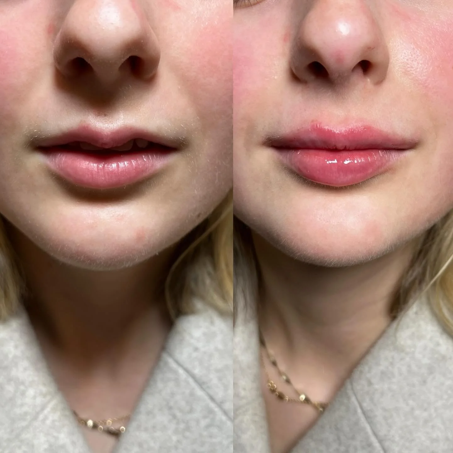 M shaped lips are my favourite lips to inject.

My beautiful client wasn&rsquo;t too bothered about the size of her lips but wanted to straightened out the &ldquo;M&rdquo; shape on the top lip whilst keeping the lips looking as natural as possible.

