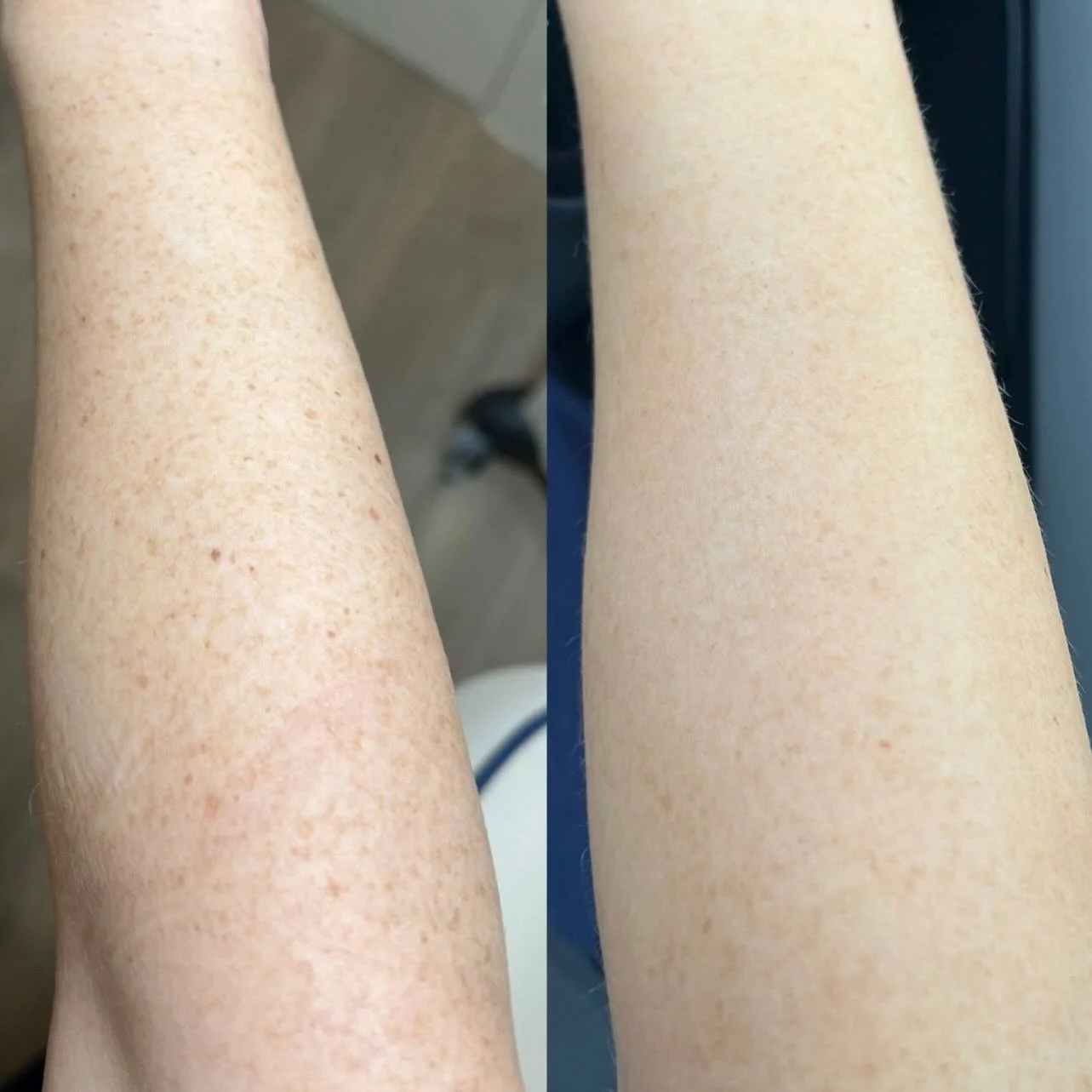 Freckle removal✨
This is after just one treatment, 1/3 will be required.