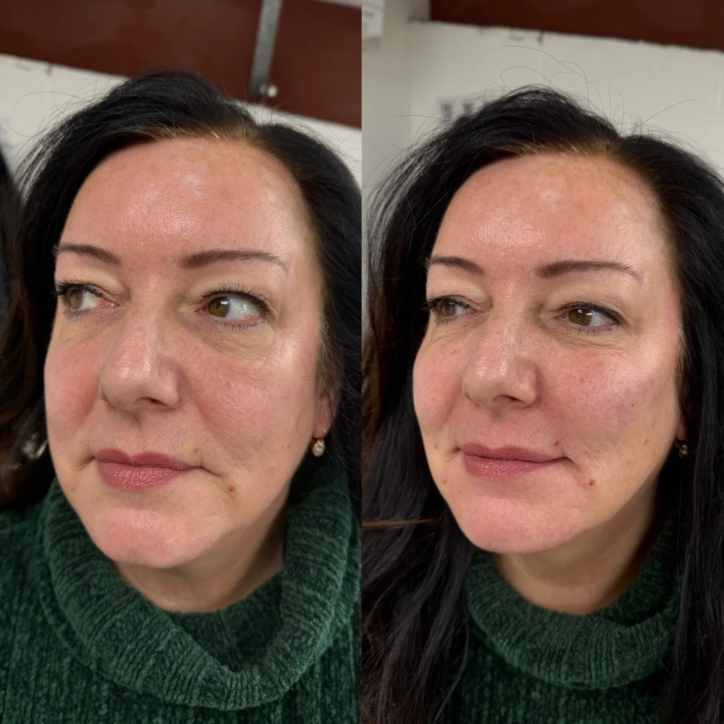 Dermal filler done properly isn&rsquo;t obvious, it just works. 🪄

We achieved this look with a 6ml package. The results are soft, balanced, and long-lasting, giving you a refreshed, youthful look while keeping movement and expression intact.

Well 