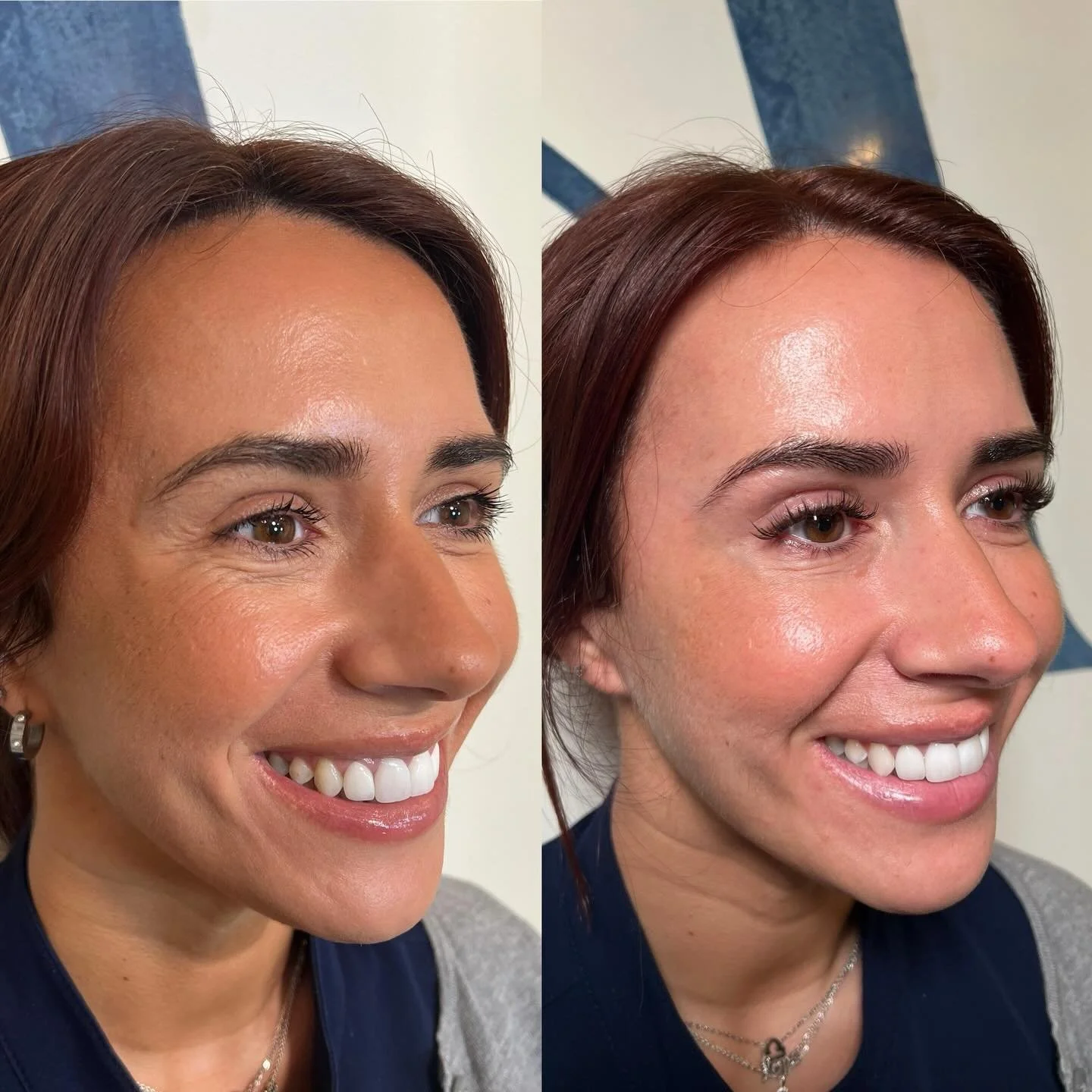 When done correctly injectable treatments should be effective yet unnoticeable✨

Beautiful results for our Soph, we wanted to target around the eyes and we did just that.