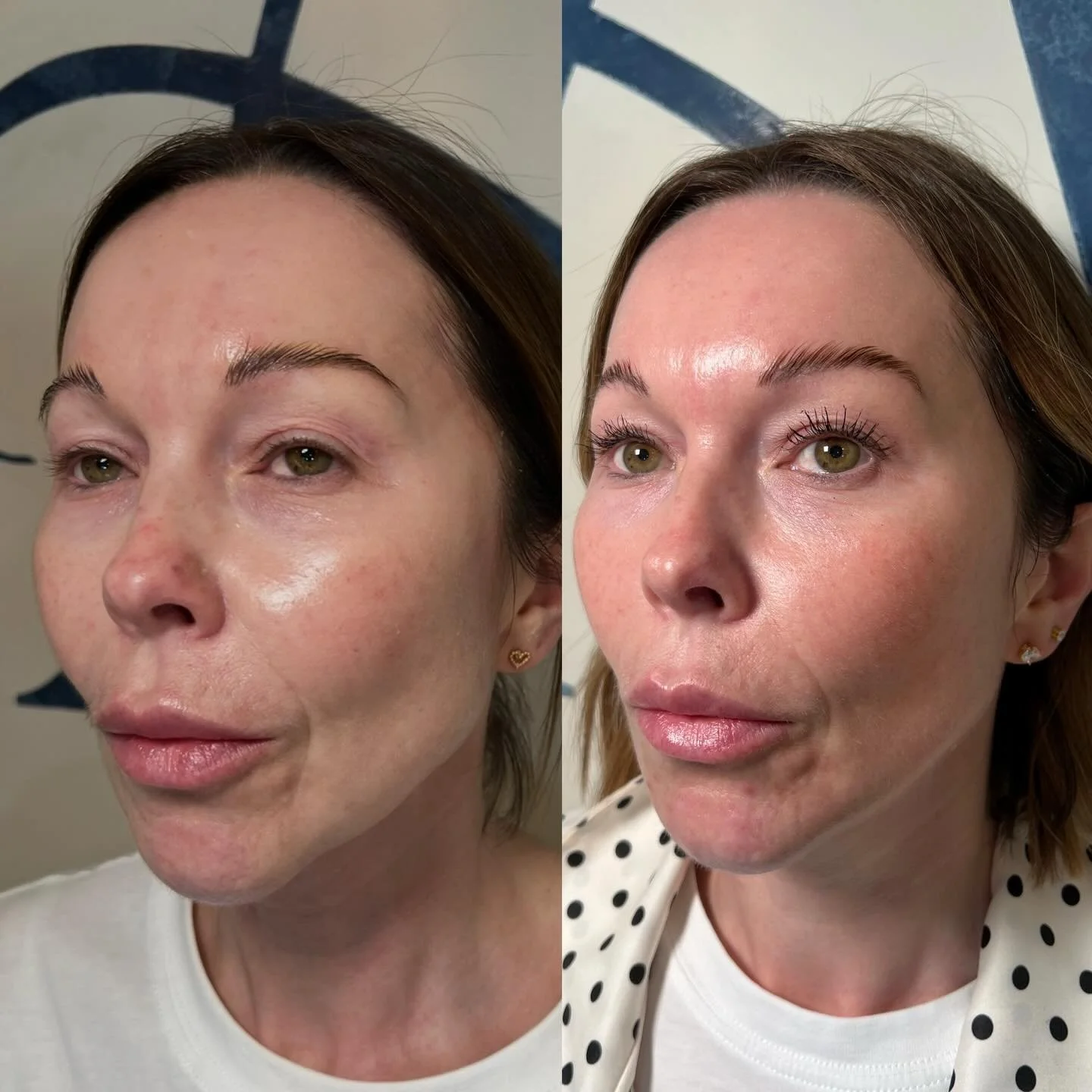Now I&rsquo;m not saying c02 laser is going to answer all of your prayers but it does come pretty close🙊

My beautiful client already had gorgeous skin and a great skincare routine so we weren&rsquo;t sure on what results she was going to get. But t