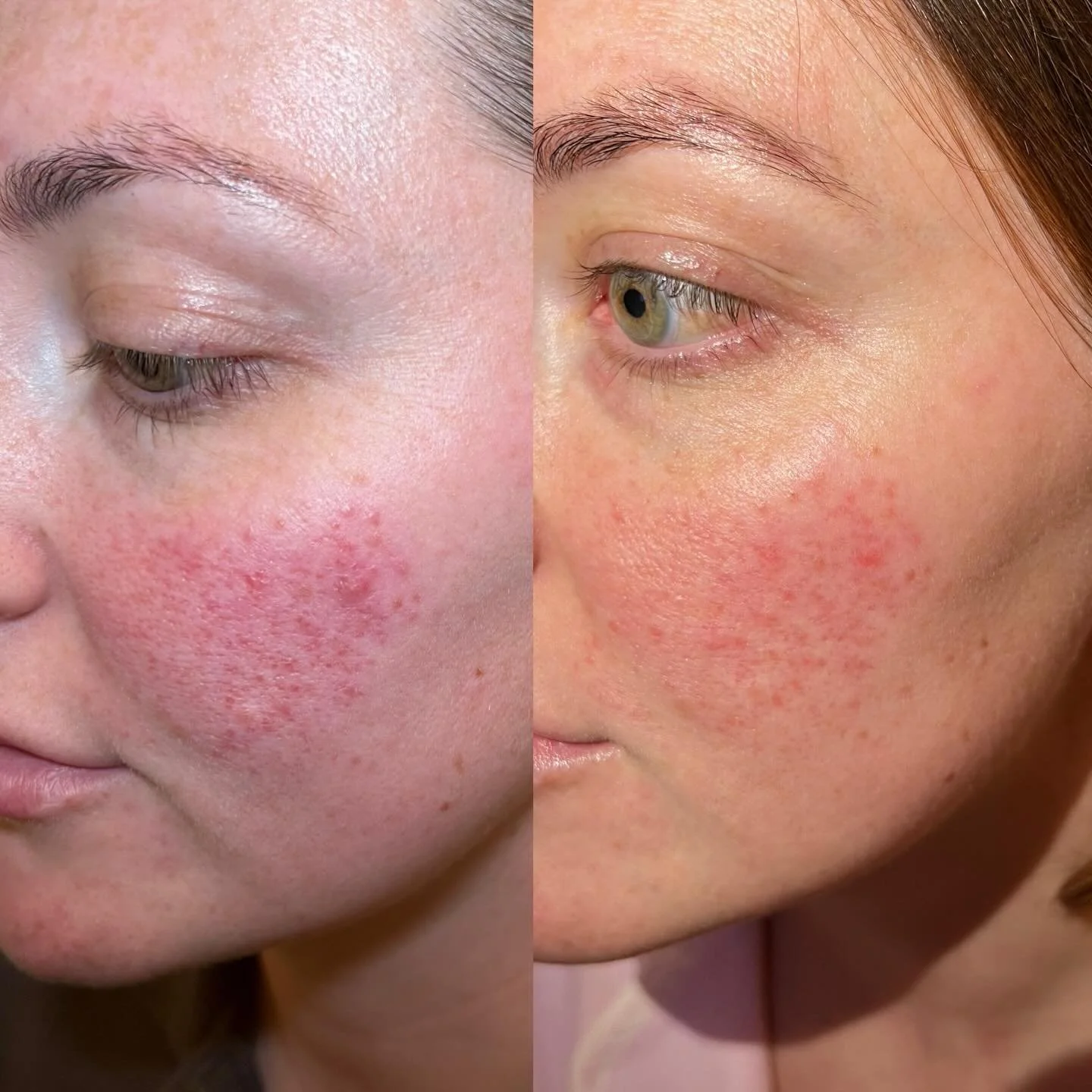 Thinking about having our Rosacea facial but haven&rsquo;t booked yet? This is your sign to get booked in!

How amazing are our clients results from just 2 sessions of laser!