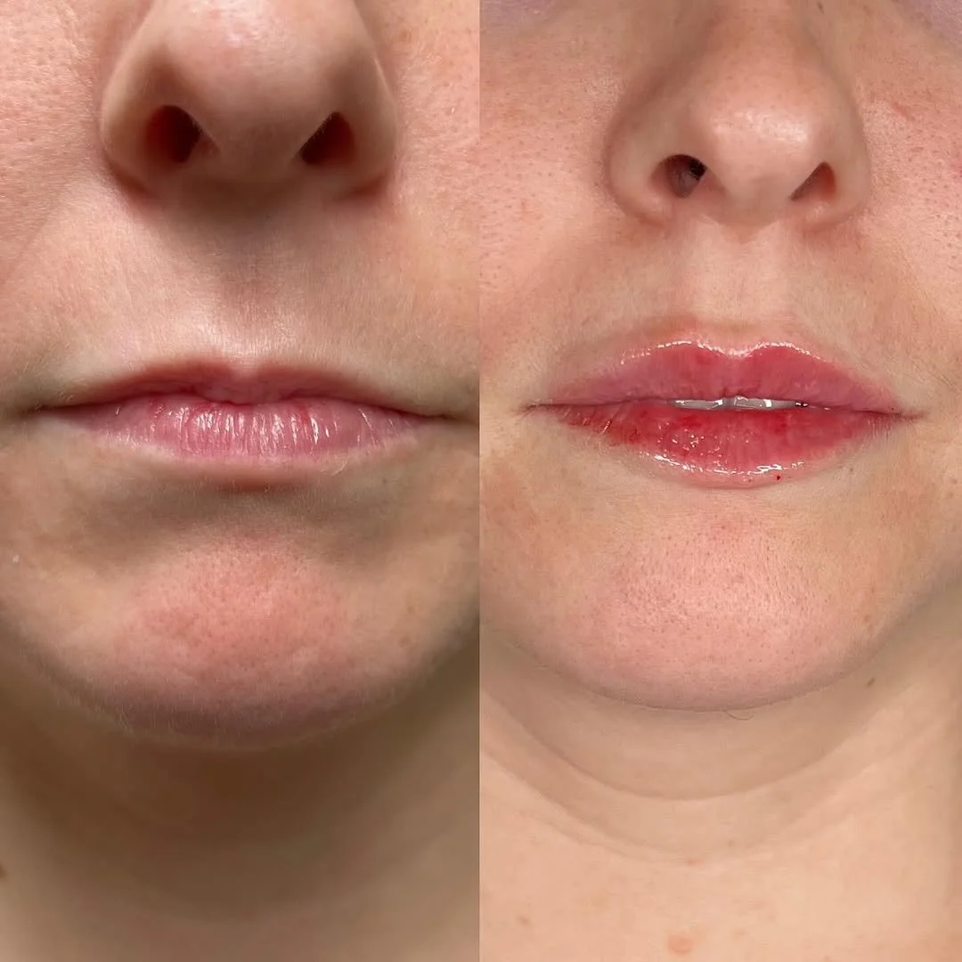 Dermal filler treatment highlighting natural beauty at The Aesthetic Clinic, Porthcawl