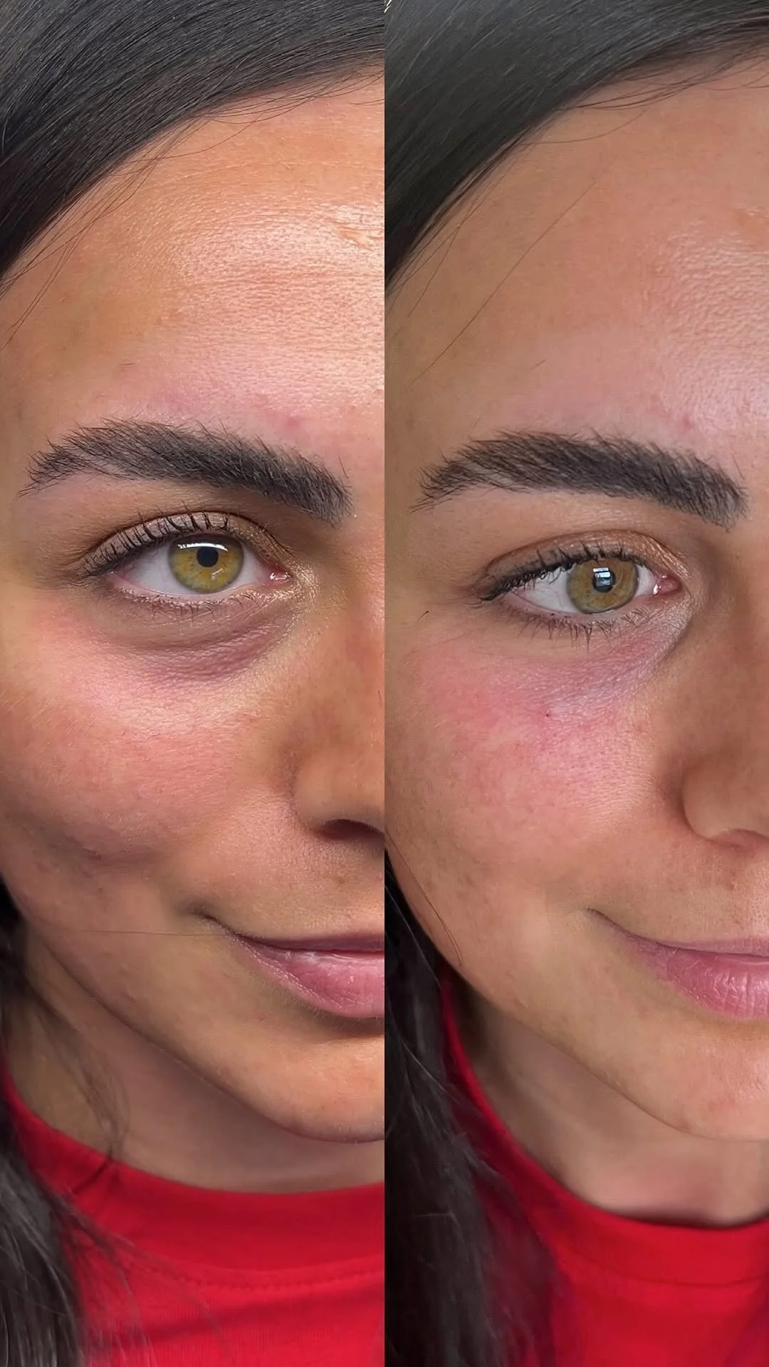 Customised dermal filler procedure enhancing lips and cheeks at The Aesthetic Clinic