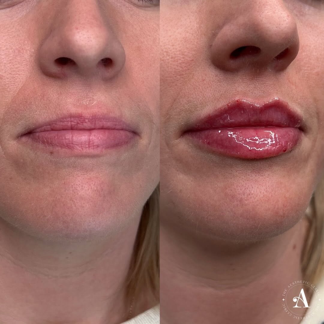 Enhancing facial harmony with precision dermal fillers at The Aesthetic Clinic, Porthcawl