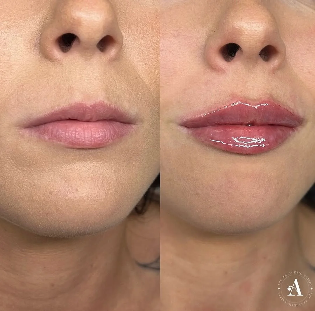 Lip augmentation with dermal fillers performed by expert aesthetic practitioner in Porthcawl