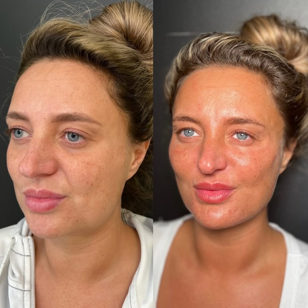 Dermal filler treatment enhancing cheek volume at The Aesthetic Clinic, South Wales