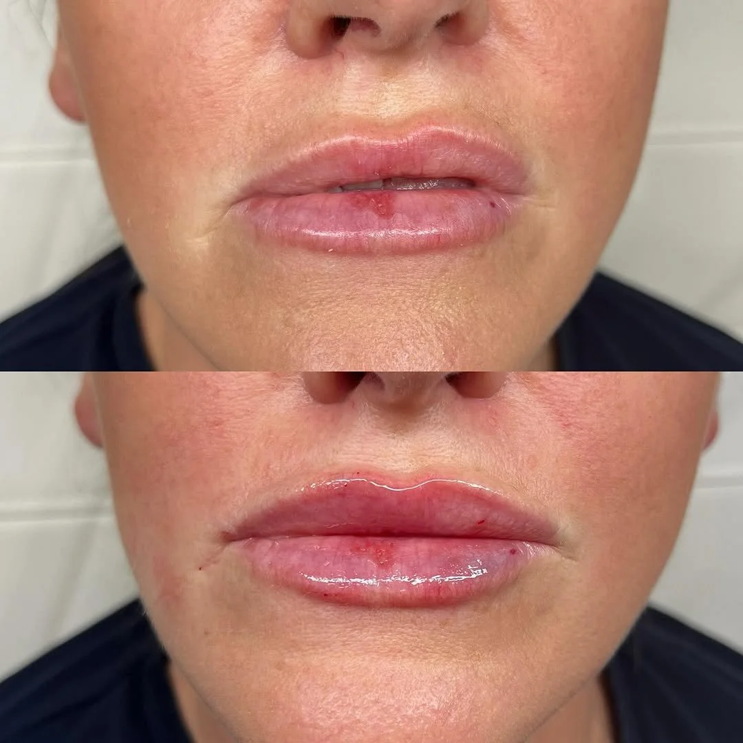 Subtle lip contouring with dermal fillers for balanced, natural results