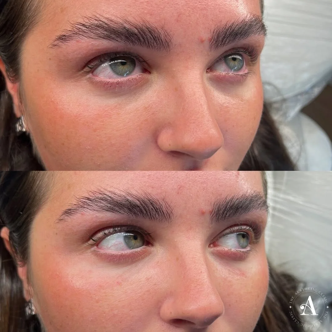 Subtle dermal filler treatment restoring youthful facial shape at The Aesthetic Clinic