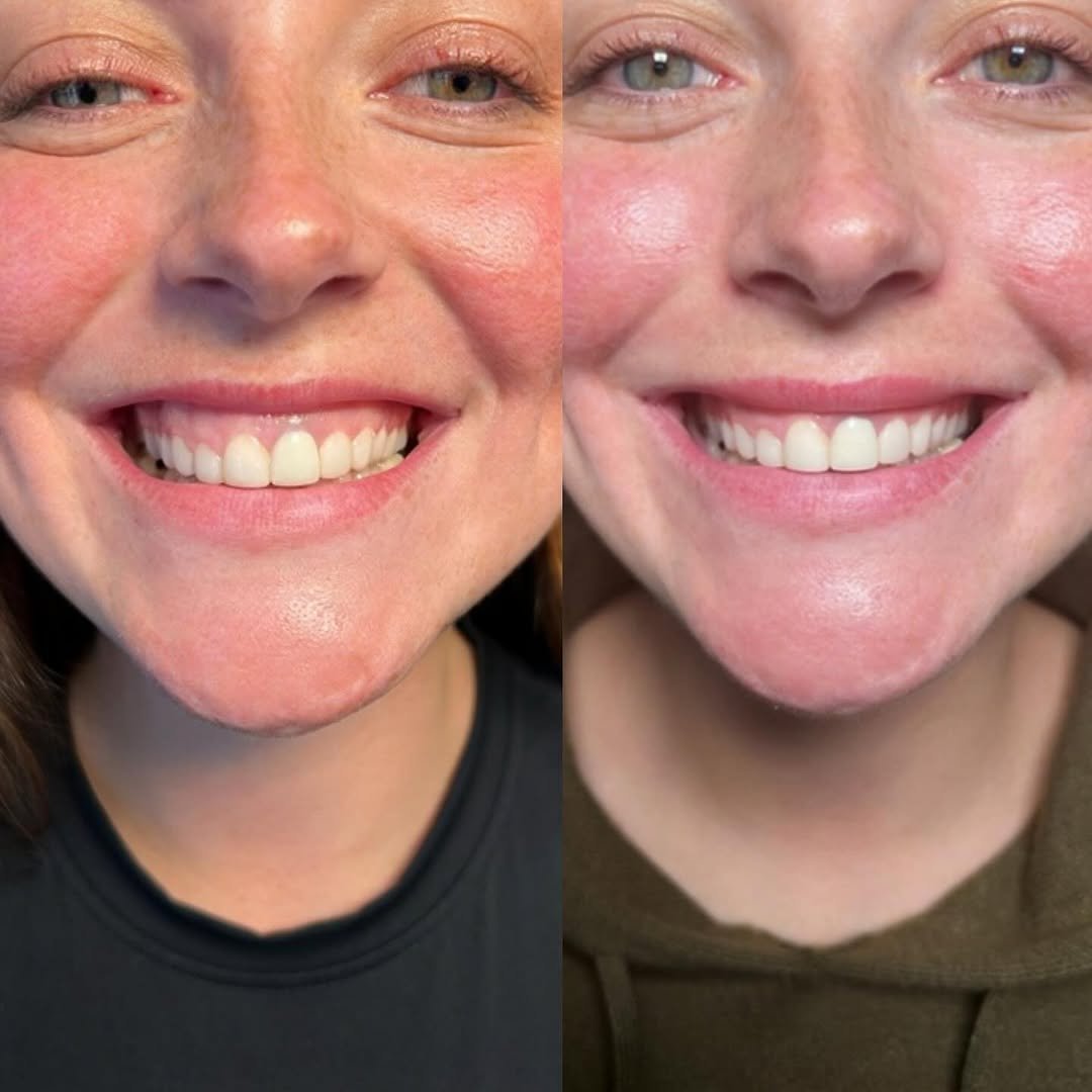 Cheek and jawline enhancement using advanced dermal filler techniques in South Wales