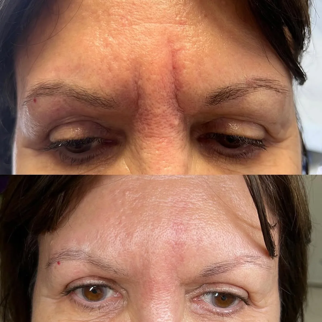 Experienced aesthetic practitioner applying dermal fillers for balanced, natural results