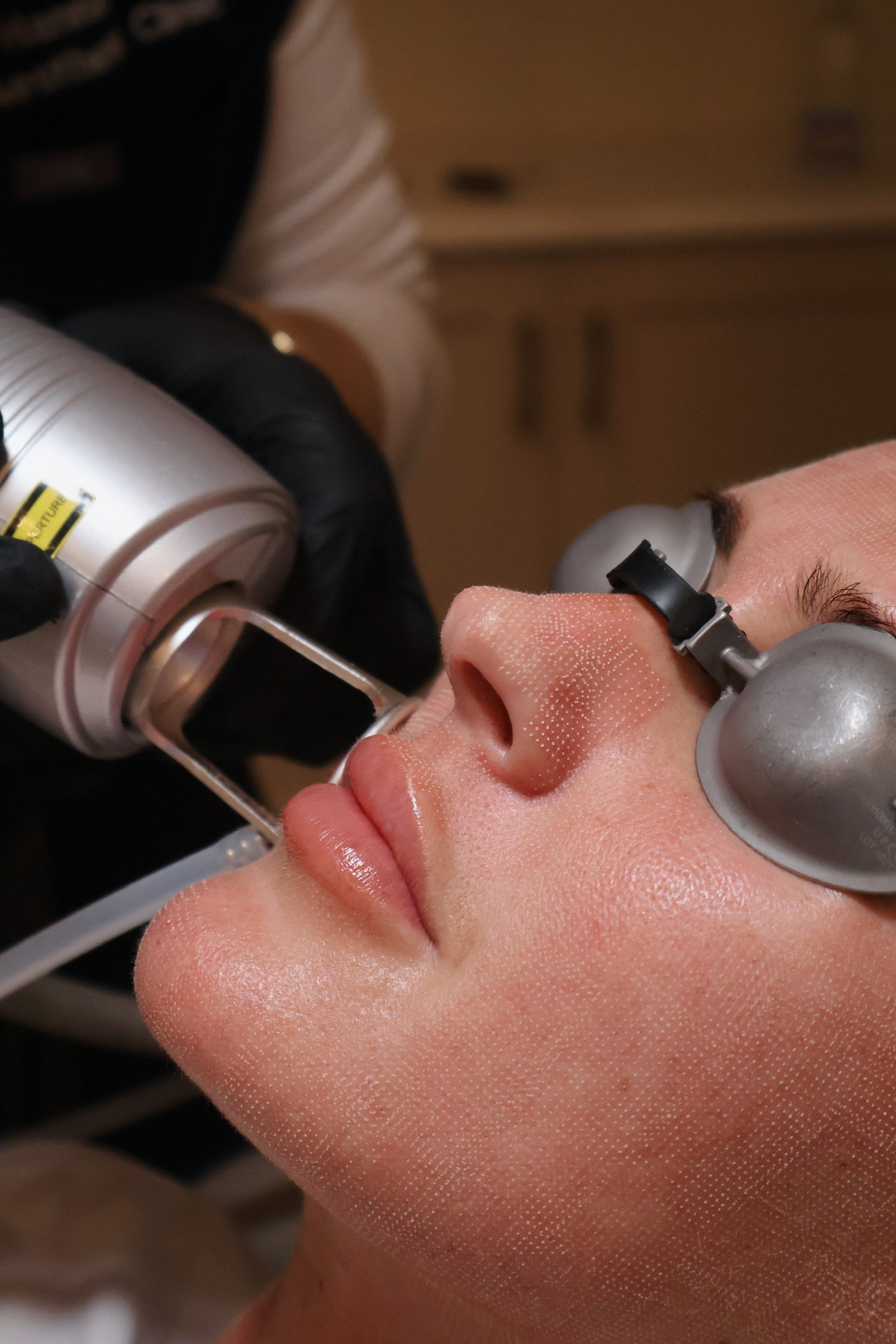 Expert practitioner performing safe laser hair removal in Porthcawl clinic