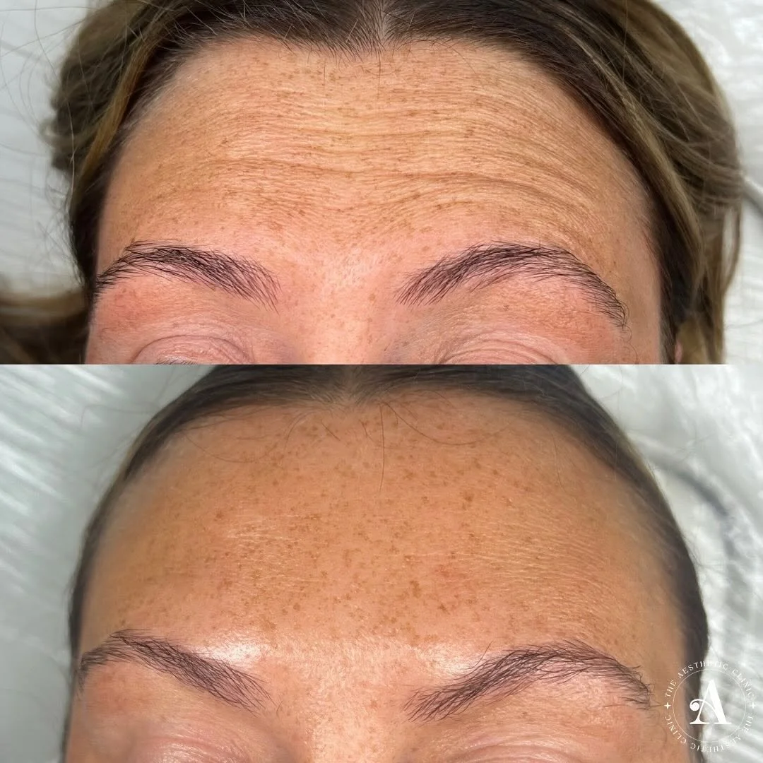 Expertly shaped dermal filler treatment for a natural, youthful smile in South Wales