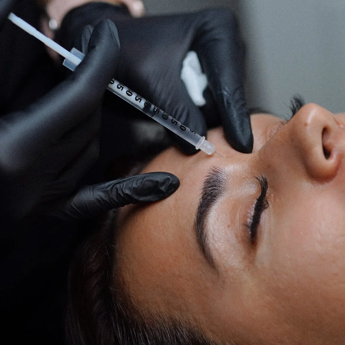 Dermal filler treatment enhancing lips and facial features at The Aesthetic Clinic, South Wales