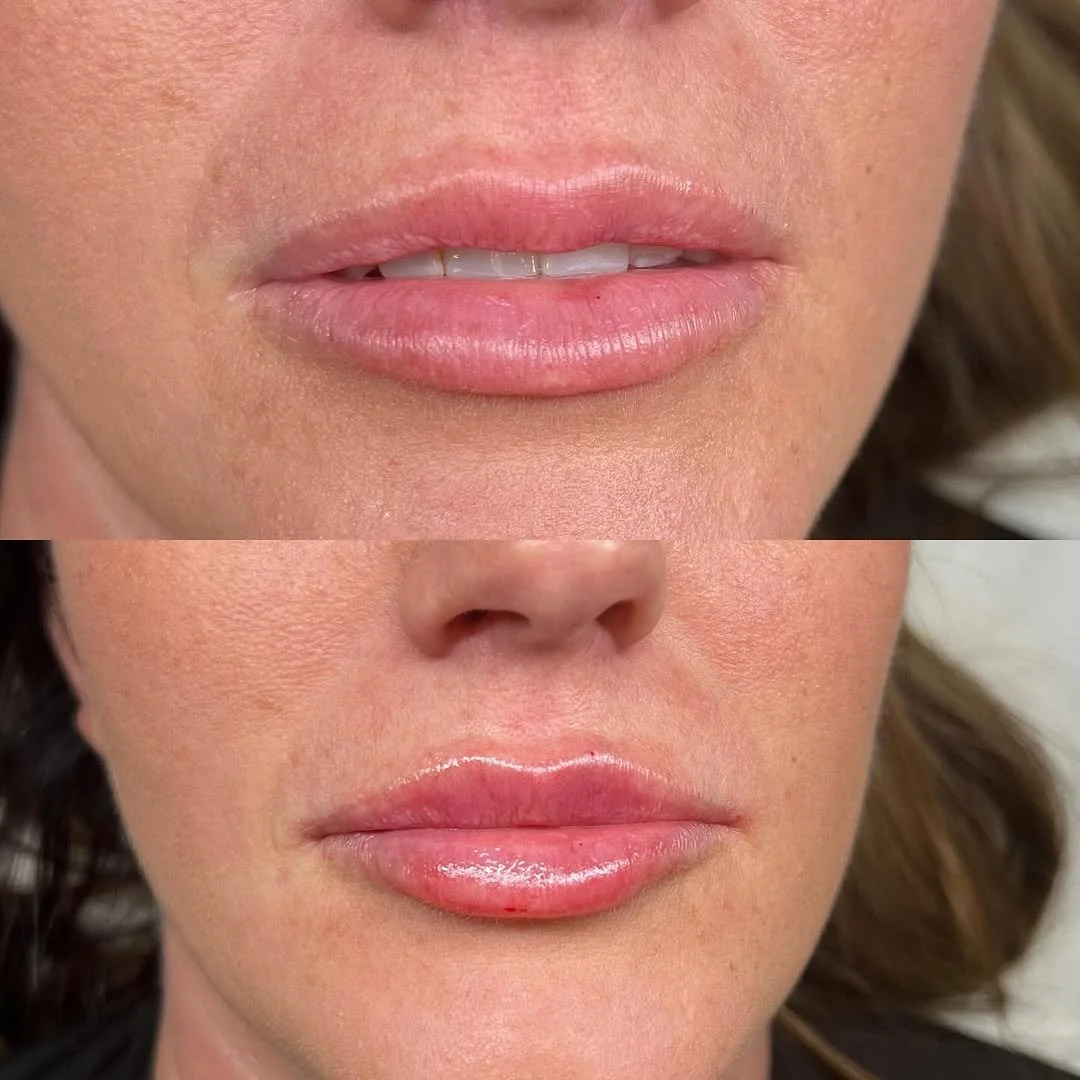 Non-surgical facial contouring using dermal fillers at South Wales aesthetic clinic