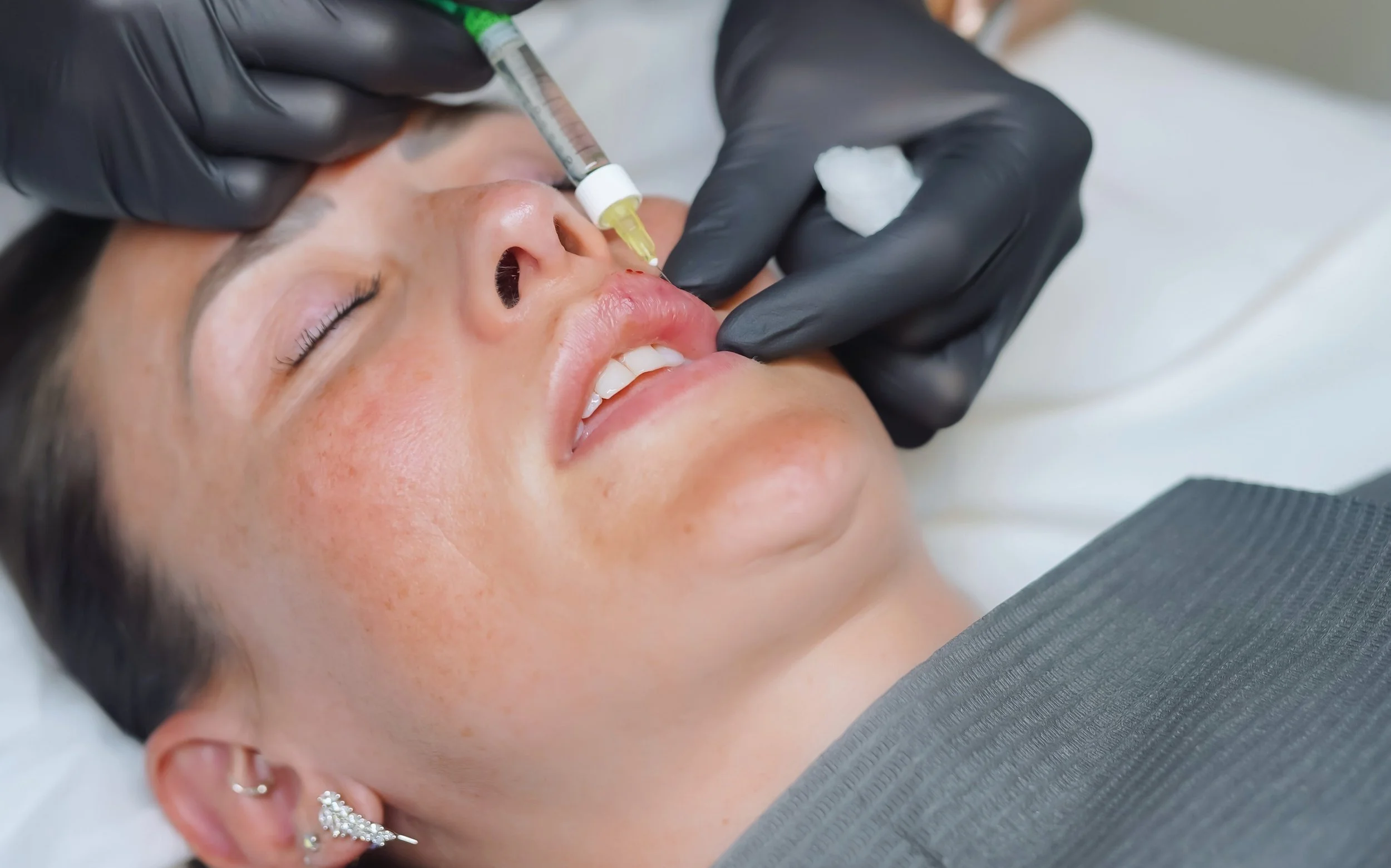 Expertly applied dermal fillers for natural results in Porthcawl clinic