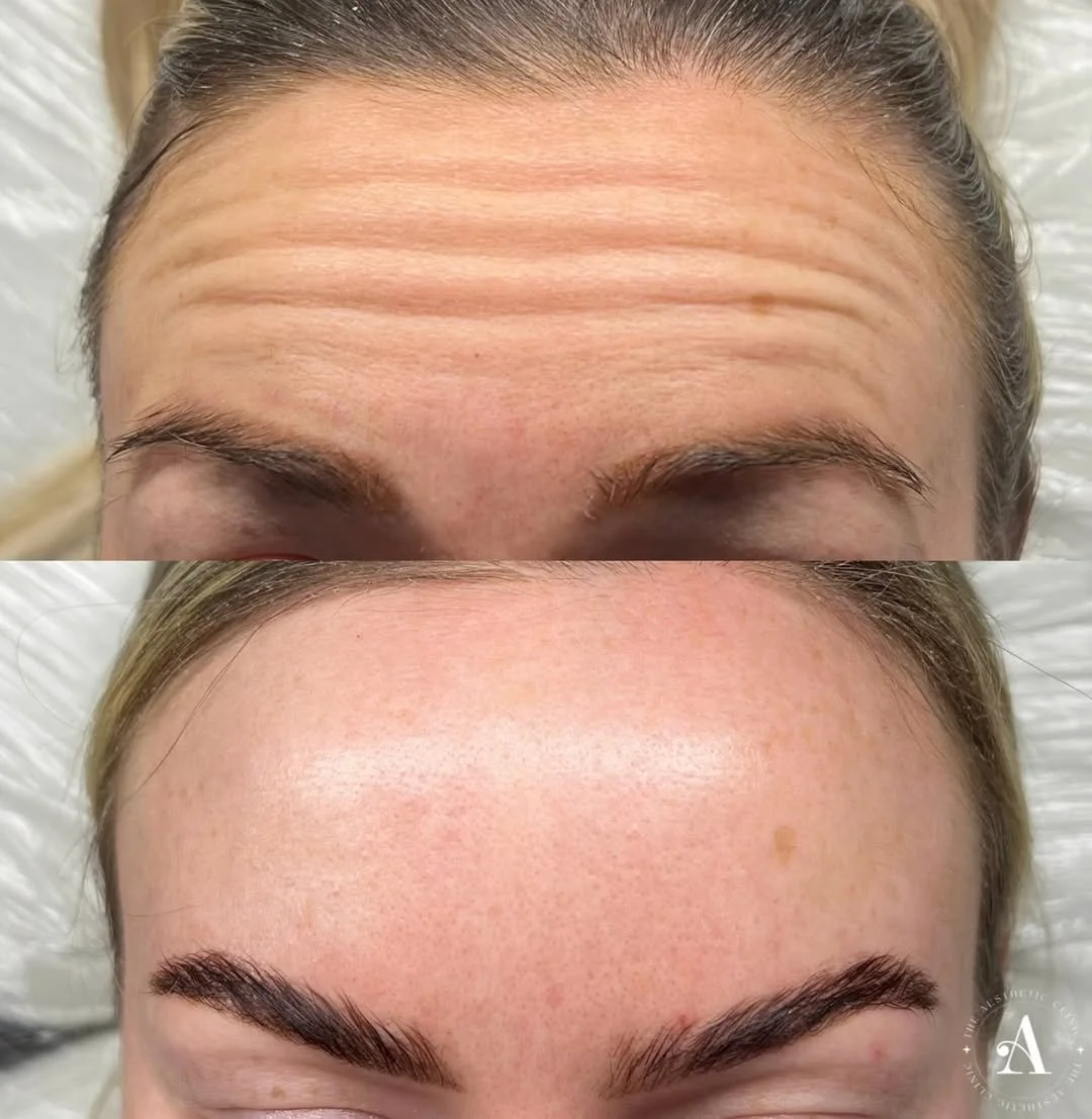 Precision dermal filler injections for natural facial enhancement in South Wales