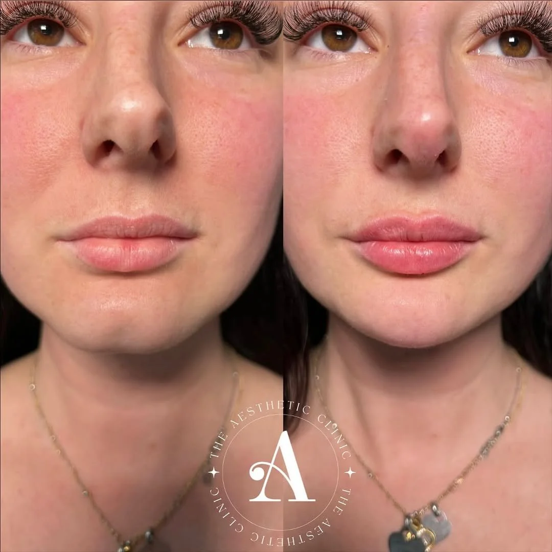 Close-up photo of a woman's face before and after cosmetic treatment, showing improved skin texture and fuller lips on the right side.