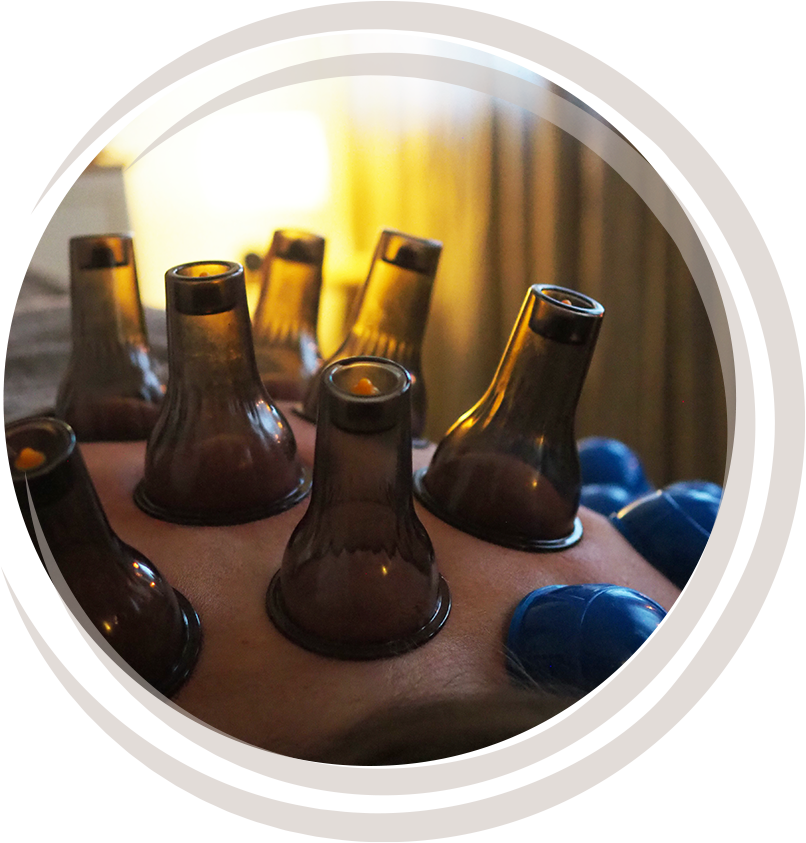 Kuvassa on akupunktionihoito, jossa on useita mustia lasiampulleja ihon päällä.