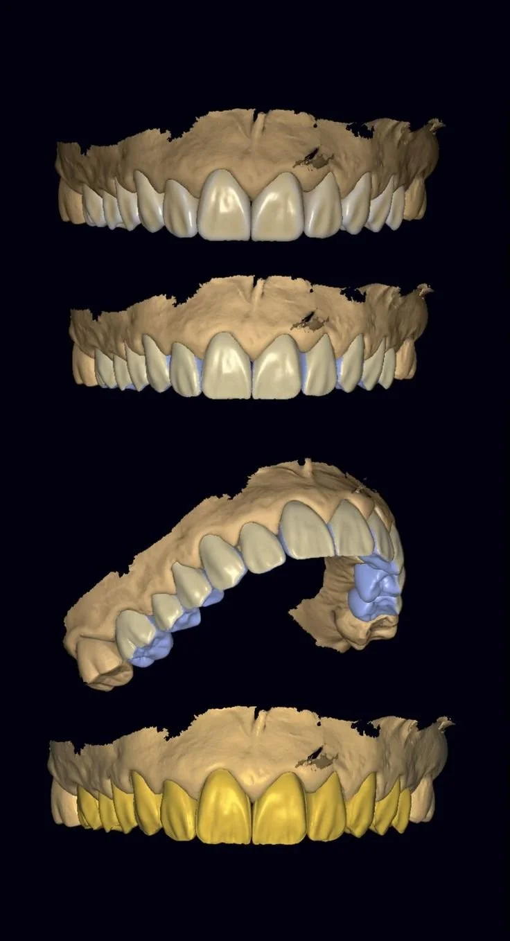 Digital 3D render of dental molds displaying upper and lower teeth from various angles, including front, side, and angled views.