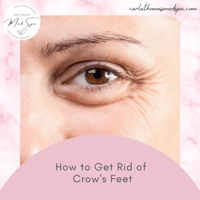 How to Get Rid of Crow’s Feet