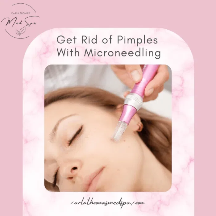 Get Rid of Pimples With Microneedling