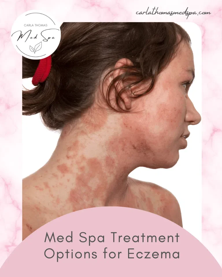 Med Spa Treatment Options for Eczema