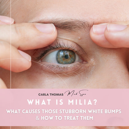 What Is Milia? What Causes Those Stubborn White Bumps &amp; How to Treat Them