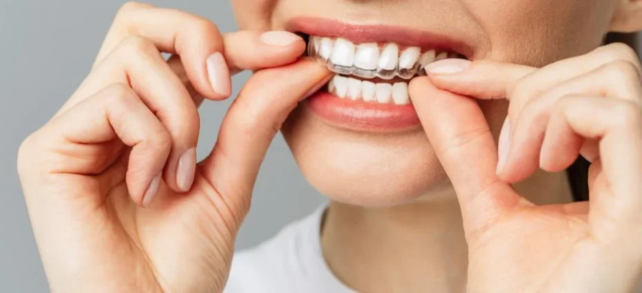 Une personne met un appareil dentaire transparent sur ses dents.