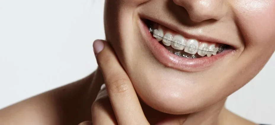 Close-up d'un sourire avec des dents orthodontiques en fil de métal.